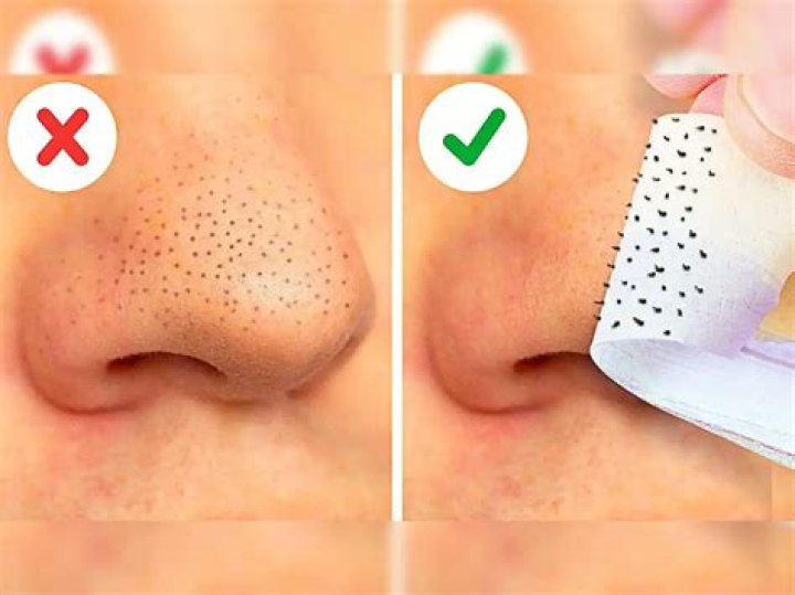 How do you get rid of spots quickly