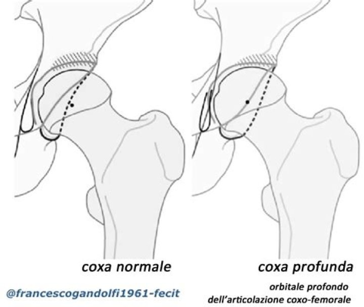 What is coxa profunda
